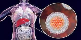 صورة توضيحية لالتهاب الكبد الوبائي
